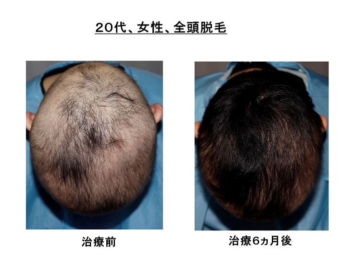 円形脱毛症　病院
